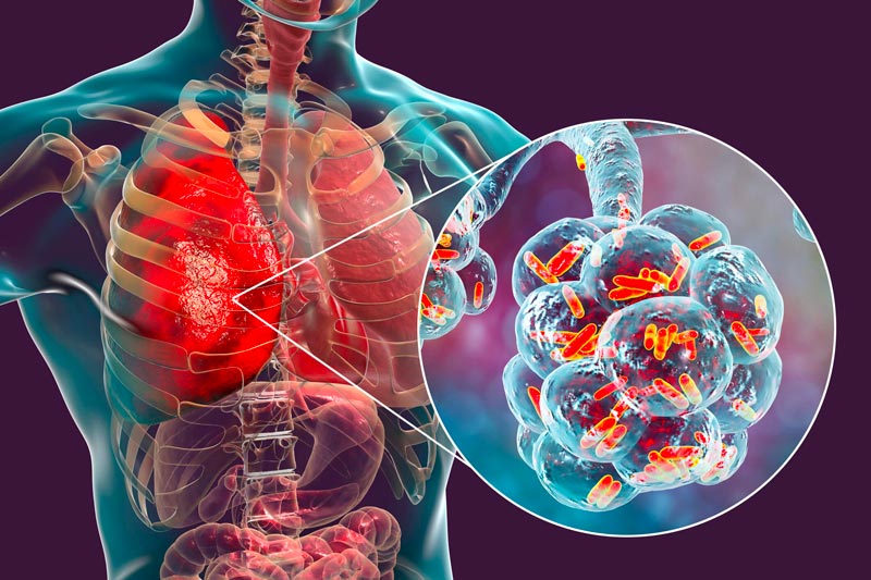 Trattamento Legionella – tutto ciò che devi sapere